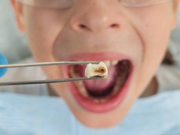 Best Broken or Chipped Tooth Repair in Mclouth, KS